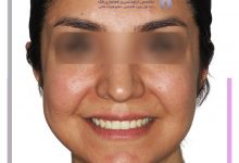 نمونه ارتودنسی ثابت شماره 93