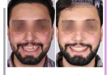 نمونه ارتودنسی ثابت شماره 118