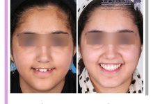 نمونه ارتودنسی ثابت شماره 119