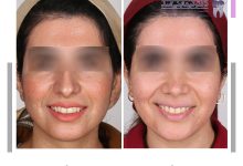 نمونه ارتودنسی ثابت شماره 120