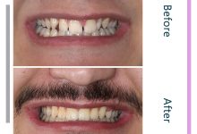 نمونه ارتودنسی ثابت شماره 121