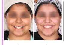 نمونه ارتودنسی ثابت شماره 122
