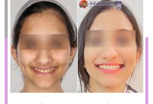 نمونه ارتودنسی ثابت شماره 123