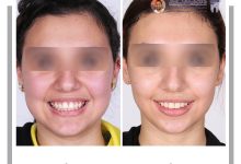 نمونه ارتودنسی ثابت شماره 124
