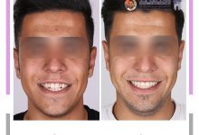 نمونه ارتودنسی ثابت شماره 125
