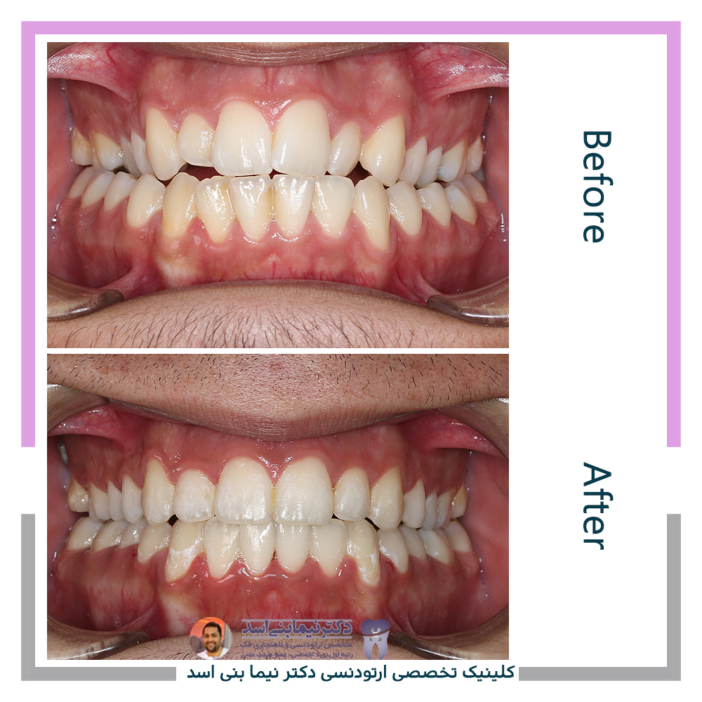 نمونه ارتودنسی ثابت شماره 125