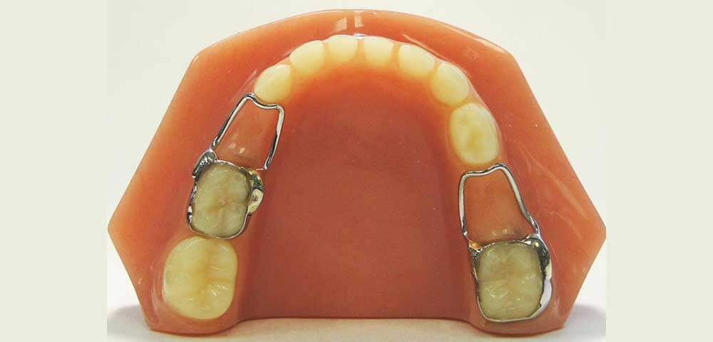 استفاده از فضا نگهدارنده های ارتودنسی