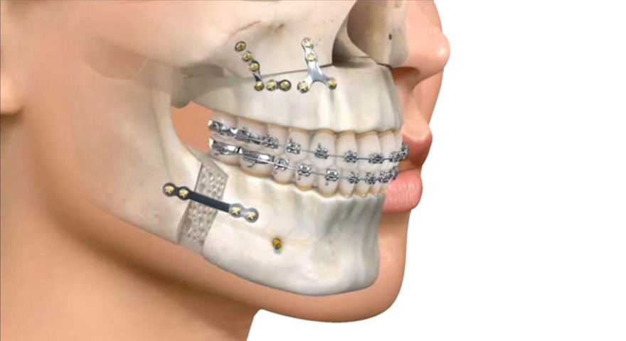 درمان های ترکیبی ارتودنسی و جراحی