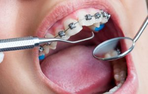 ارتودنسی دندان و کاربرد آن