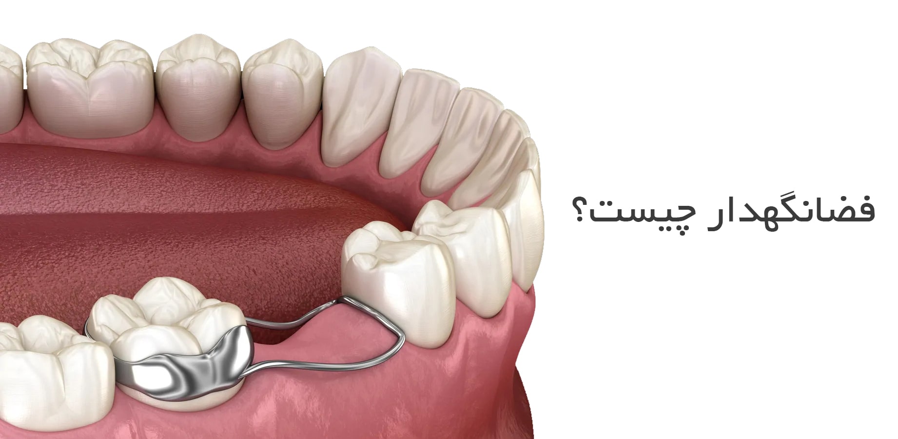 فضا نگهدار ارتودنسی چیست و چه کاربردی دارد؟